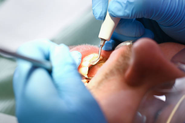 Best Emergency Treatment for Toothache in Fort Irwin, CA