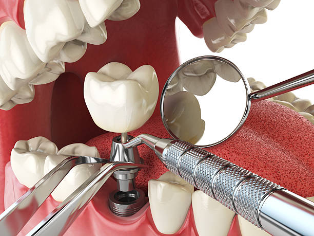 Best Emergency Tooth Extraction in Fort Irwin, CA
